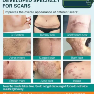 Advanced Scar Spray For All Types of Scars - For example Acne Scars, Surgical Scars and Stretch Marks